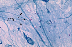 AFB Stained by Ziehl-Neelsen Staining Procedure(33922 bytes)
