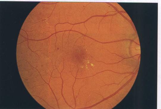 retinopatia neproliferativa