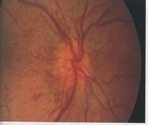 retinopatia proliverativa